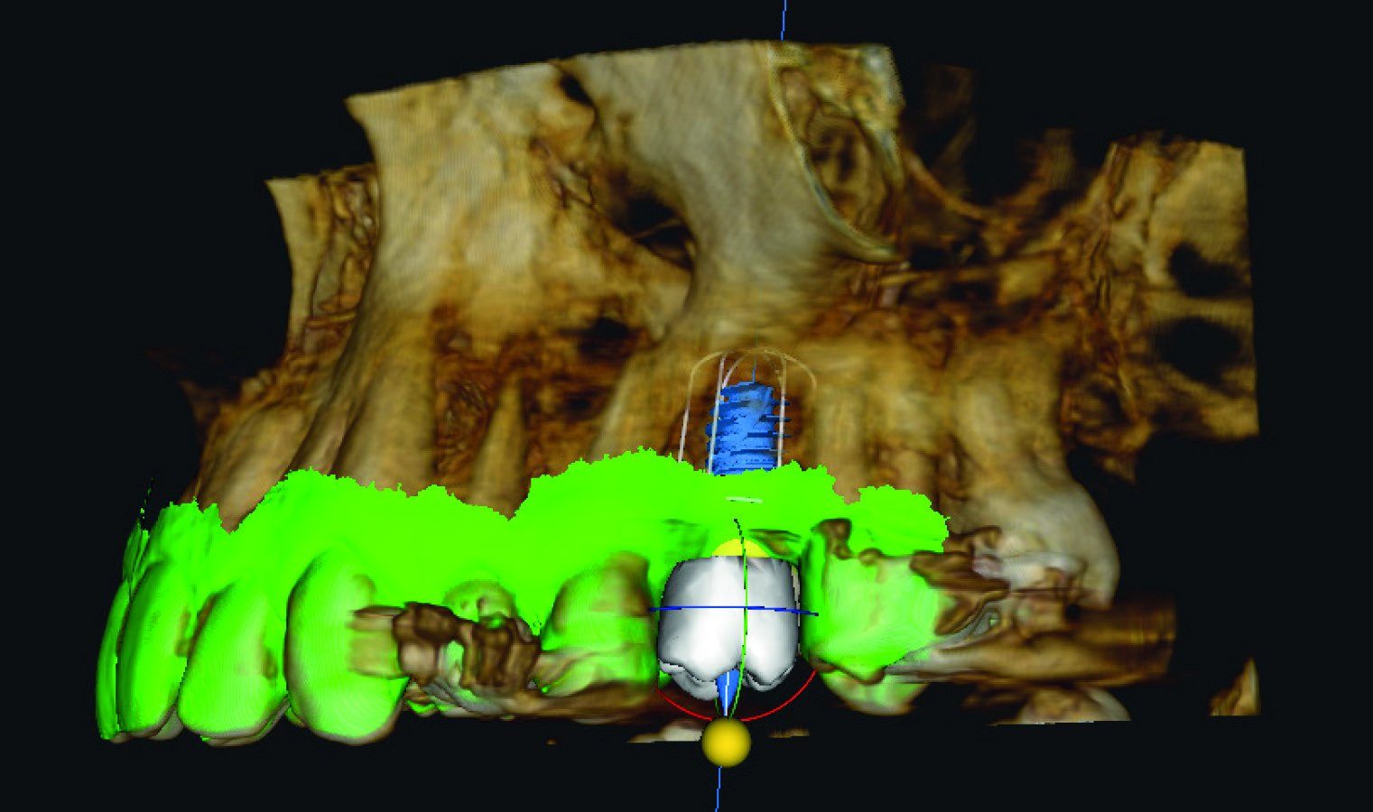 AI-planned crown and implant in the UL6 site on a CBCT 3D render with intraoral scan overlay
