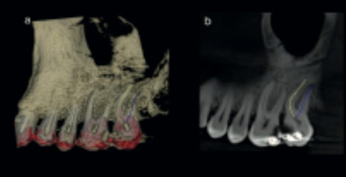 CBCT root canal tracing of the buccal roots of an upper left second molar (UL7) in Carestream software
