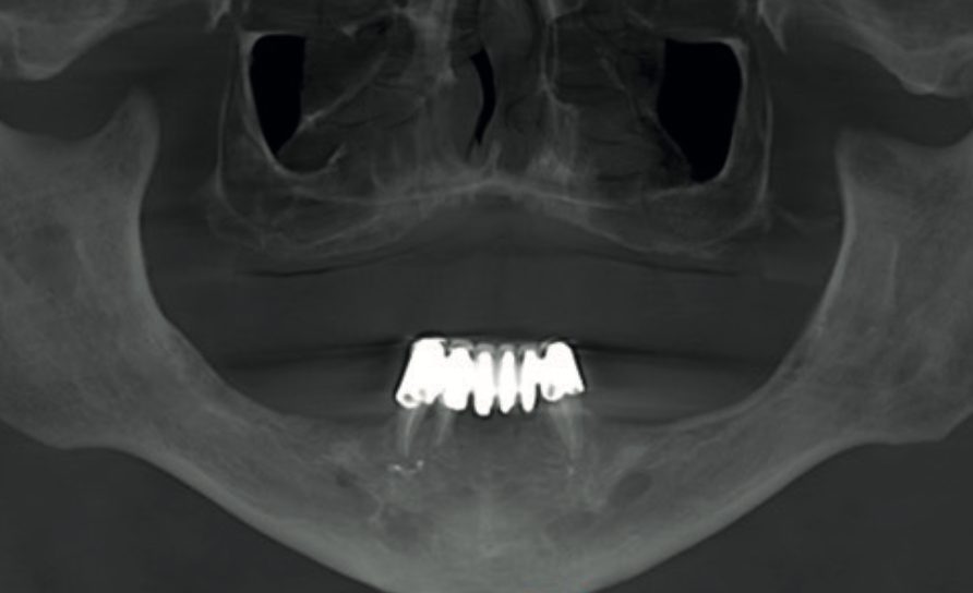 Reformatted panoramic CBCT view of an edentulous maxilla showing the full field of view