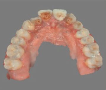 Occlusal view of a digital impression of the upper arch captured with an intraoral scanner